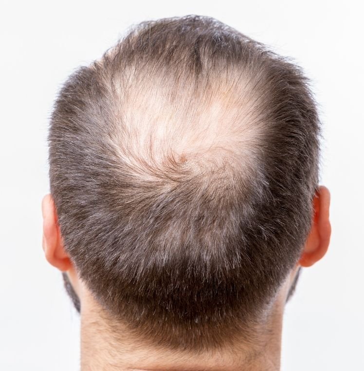 hair loss treatment