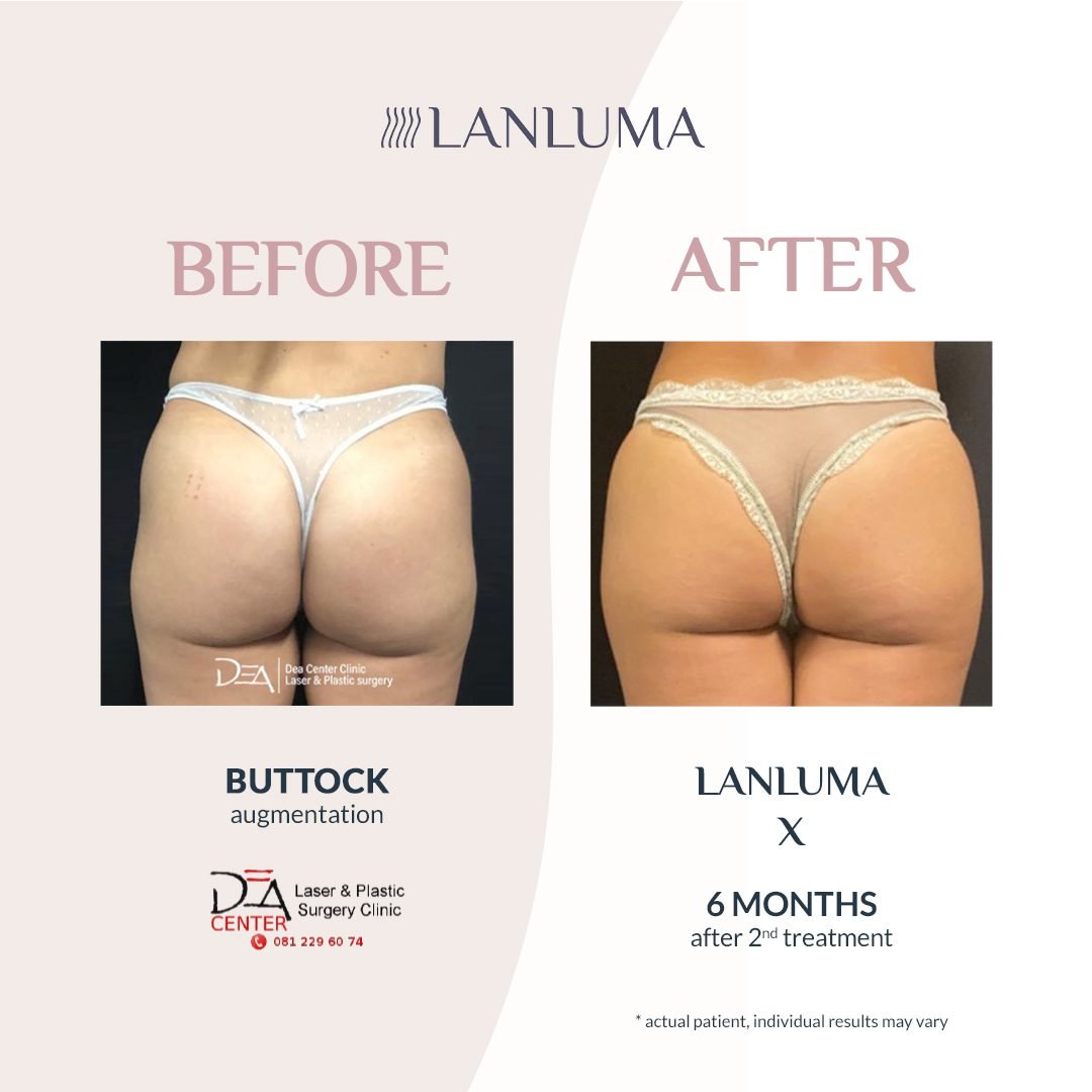 lanluma before after