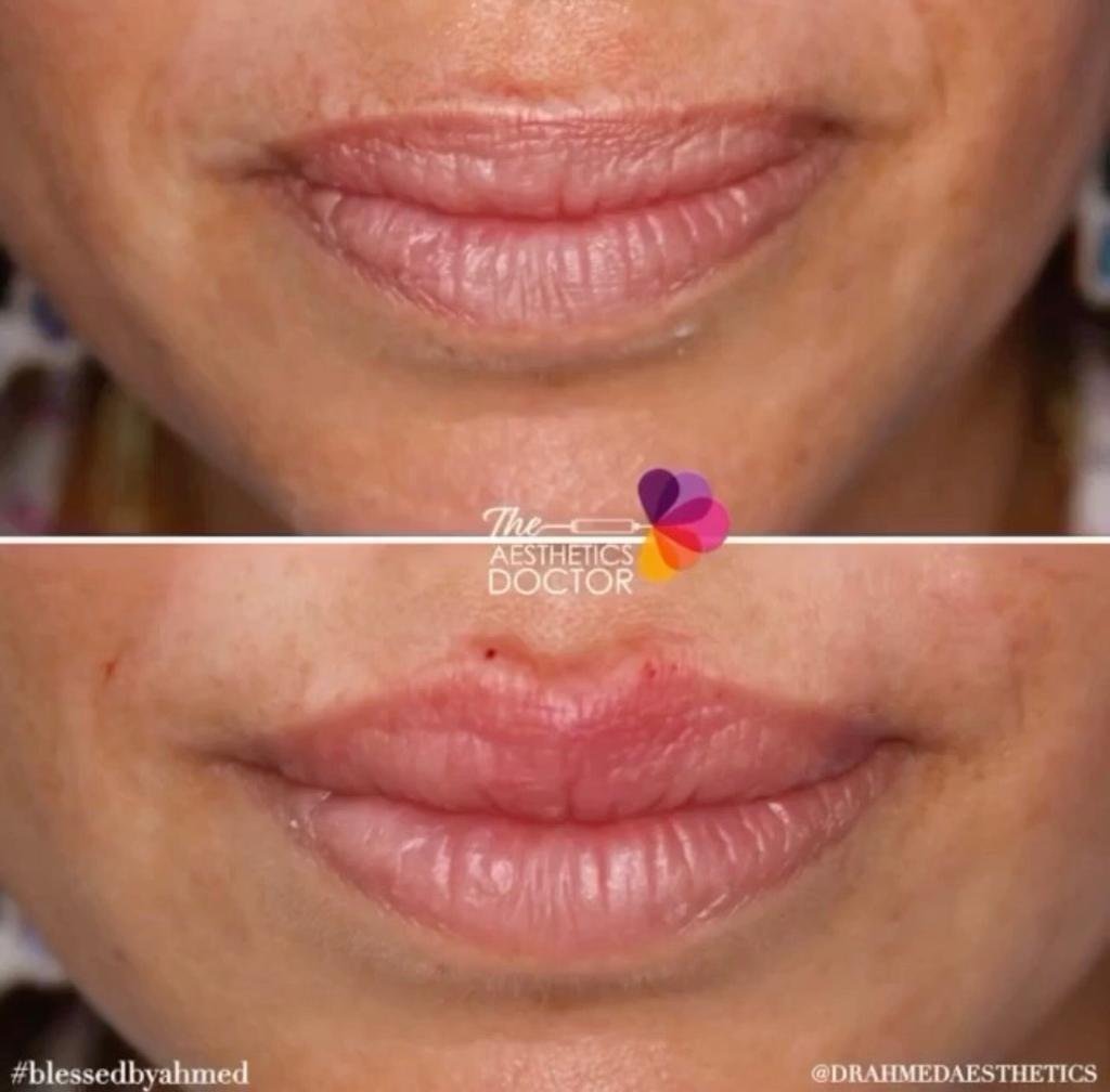 lip filler results cheshire