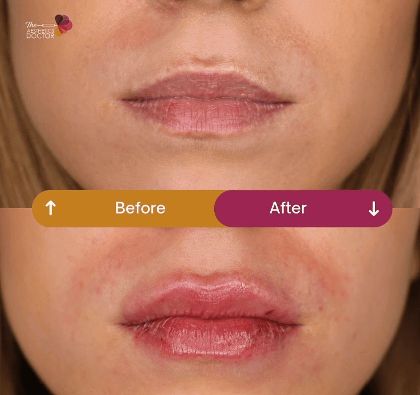 lip fillers london