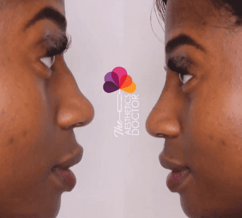 liquid nose job