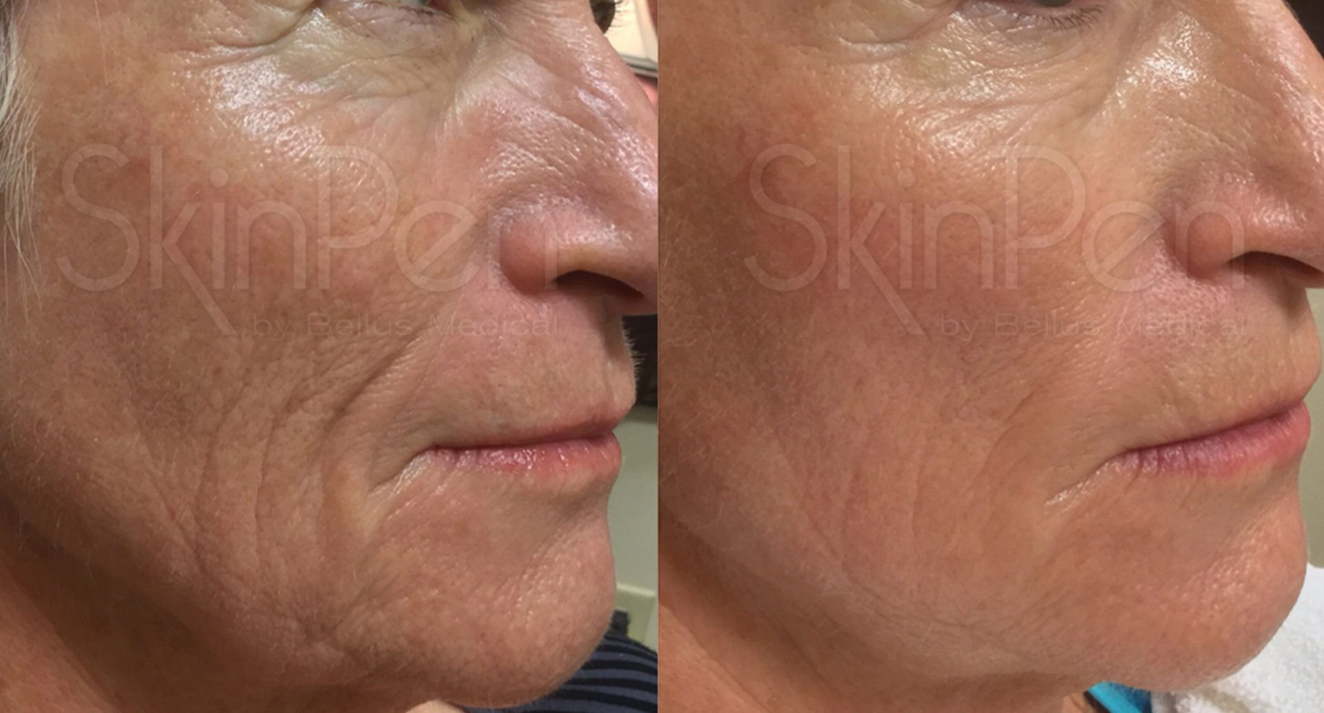 microneedling before and after 