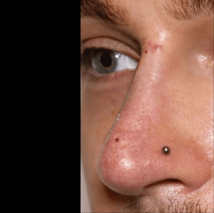 non rhinoplasty after cheshire