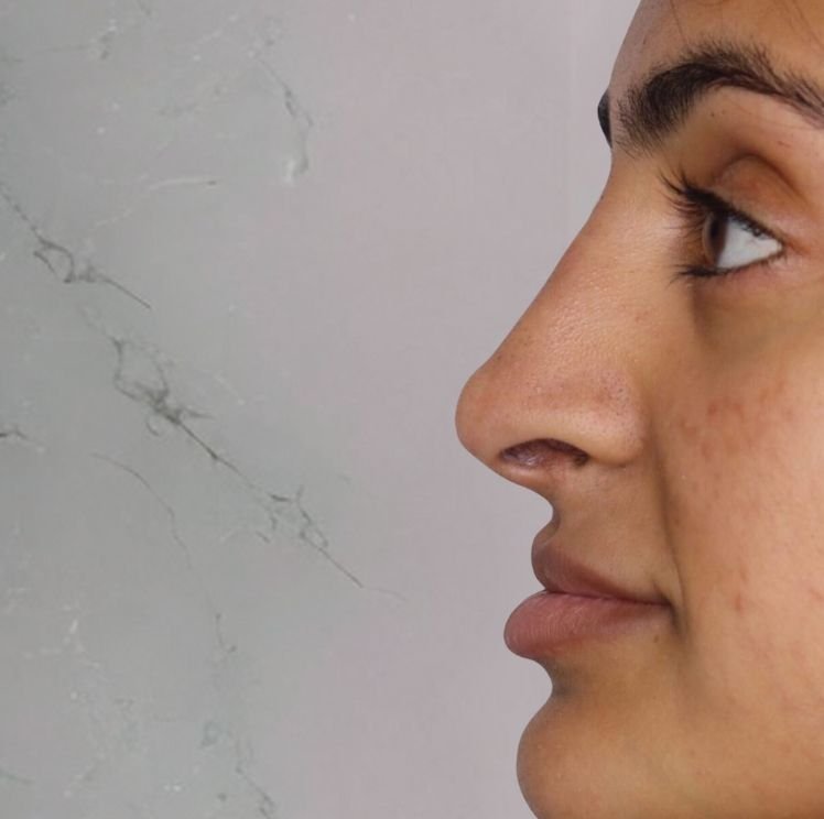 non rhinoplasty after leeds