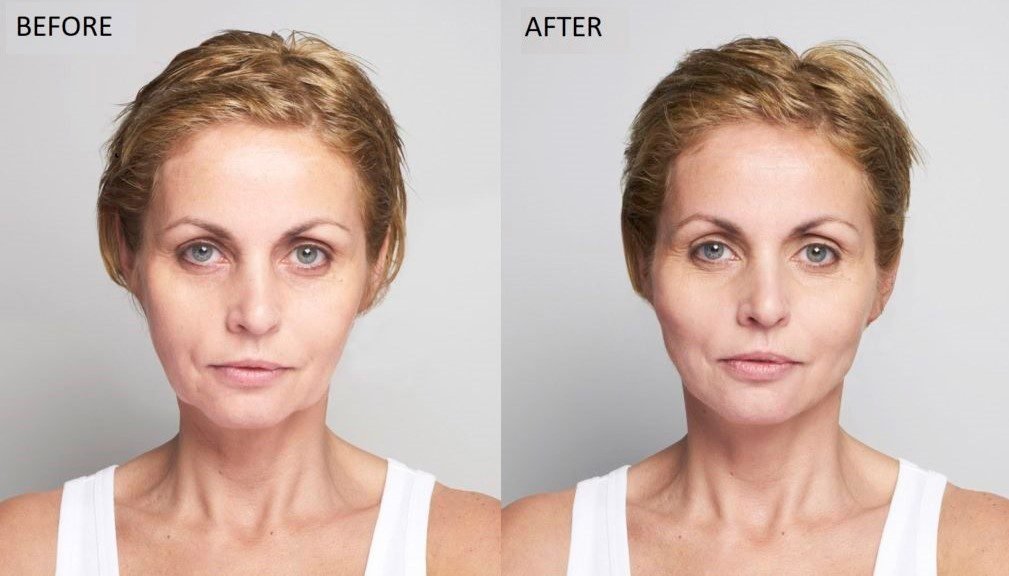 non-surgical-face-lift before and after