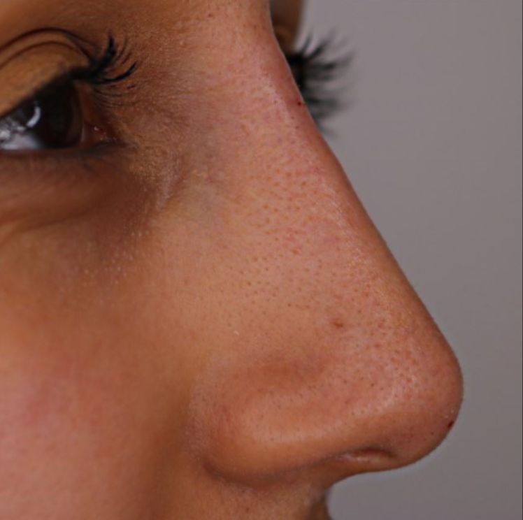 non surgical nose job after