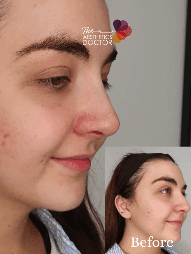 non surgical nose job