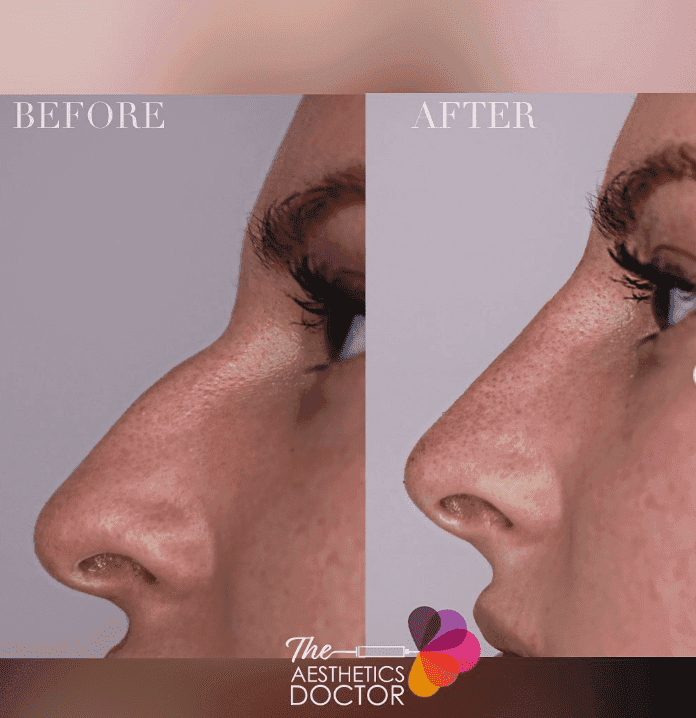 Before and after of a woman receiving non surgical rhinoplasty