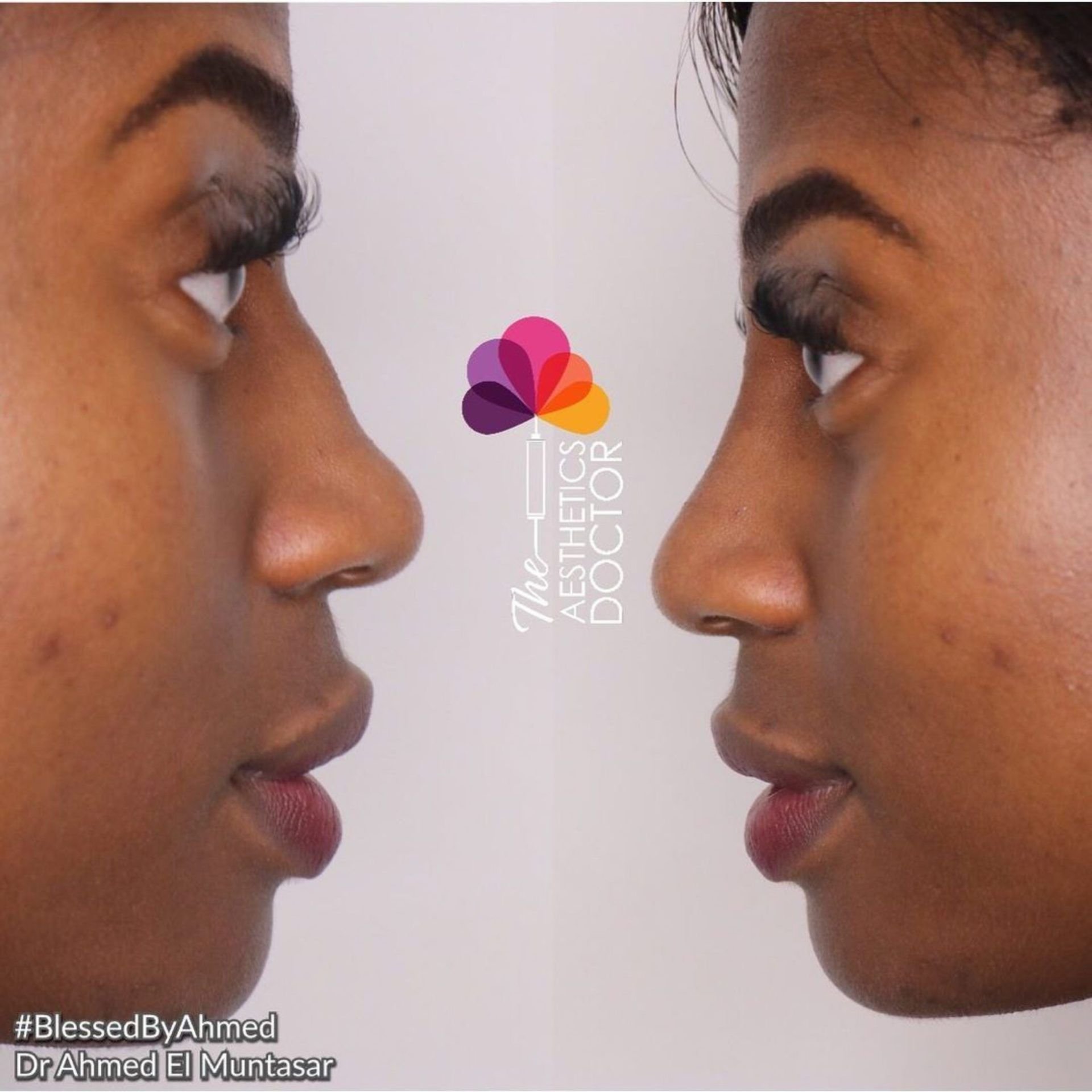 Before and after after a patient who is a woman receives non surgical rhinoplasty