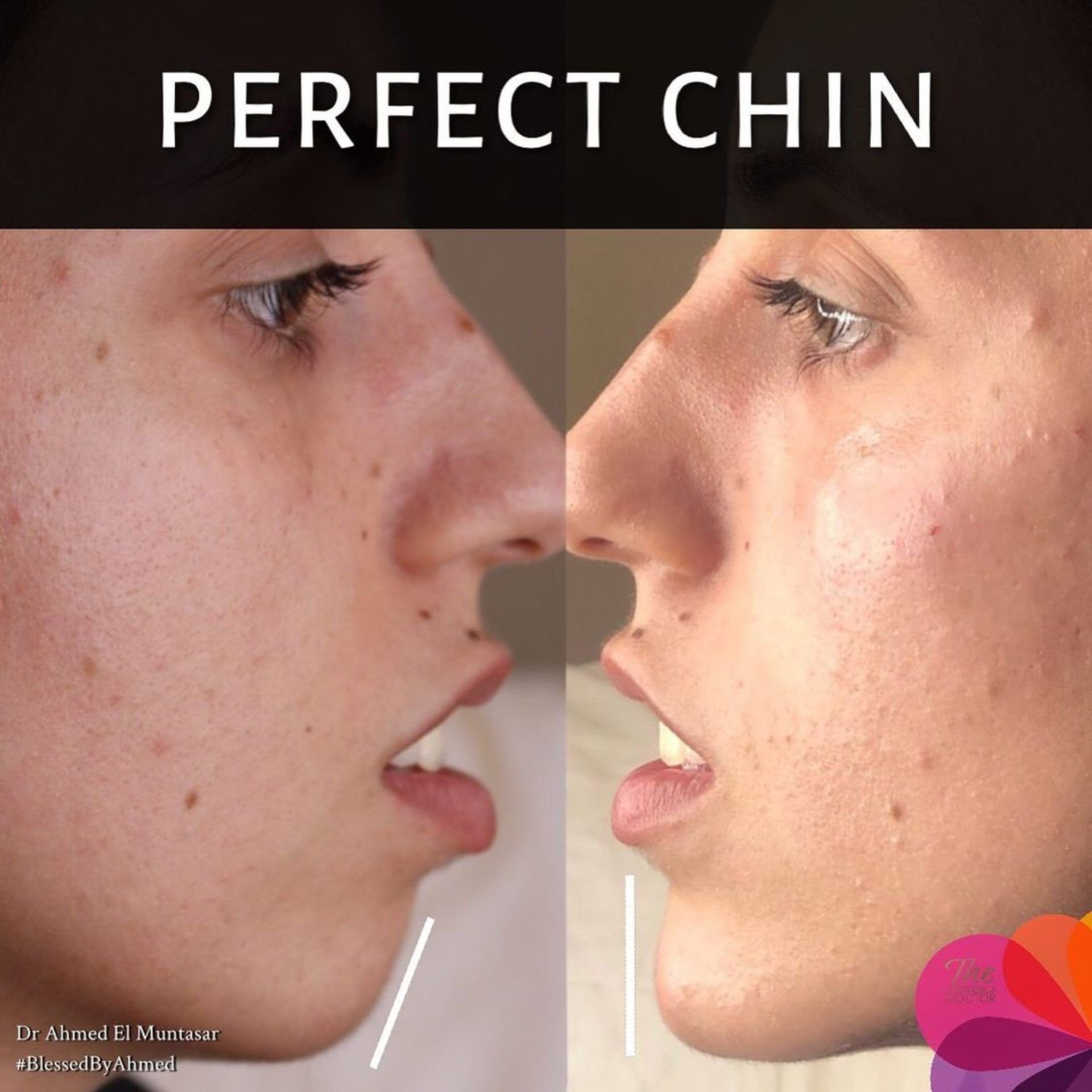 pebble chin before after