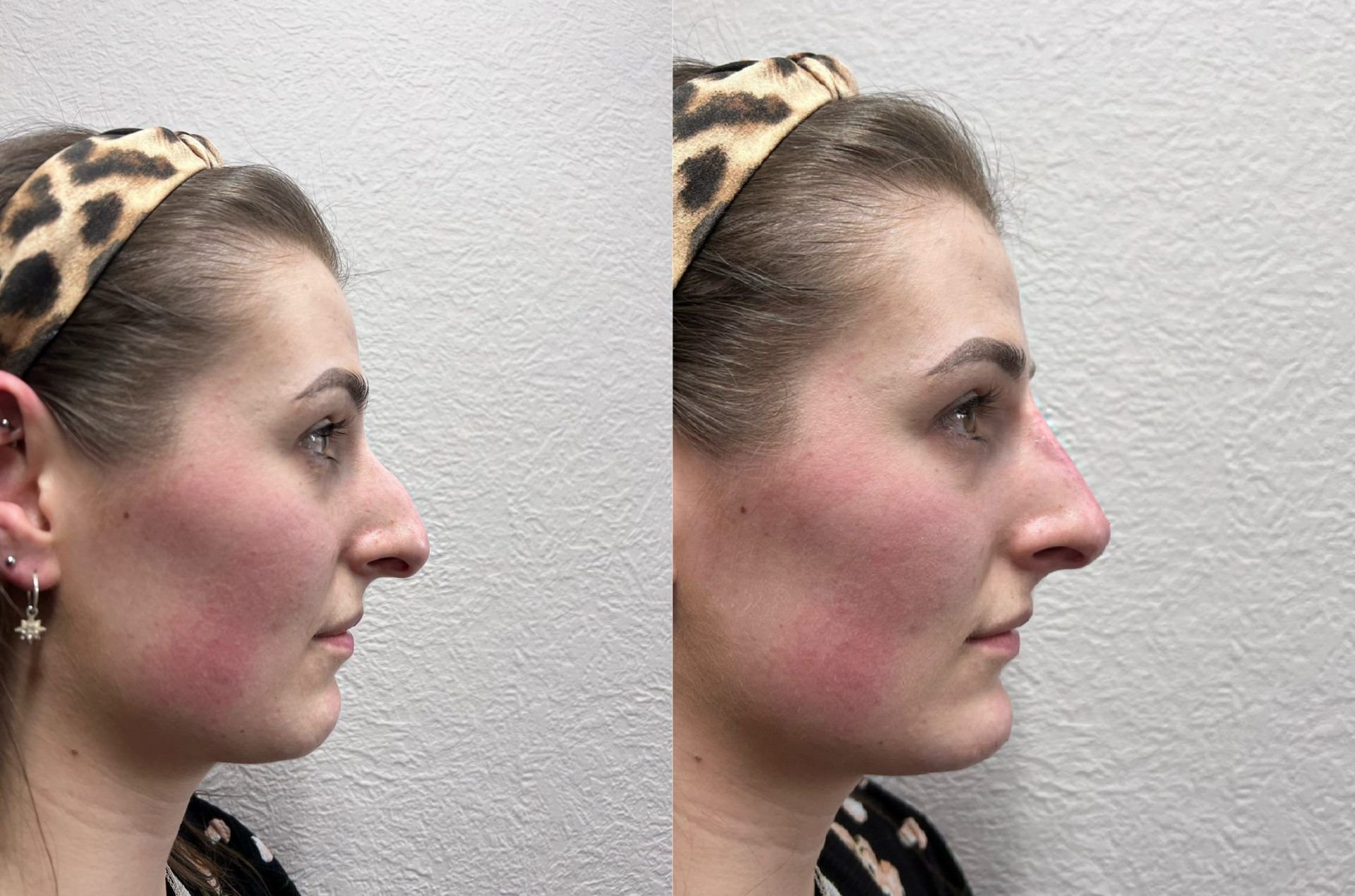 Before and after of a woman looking sideways after profilioplasty treatment