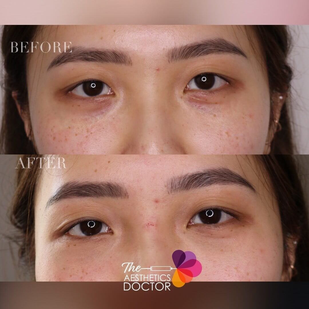 tear trough asian before and after