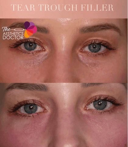 Tear Trough Filler Before and after