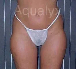 Aqualyx Injections for Love Handles: A Complete Guide to Achieving a Sculpted Body