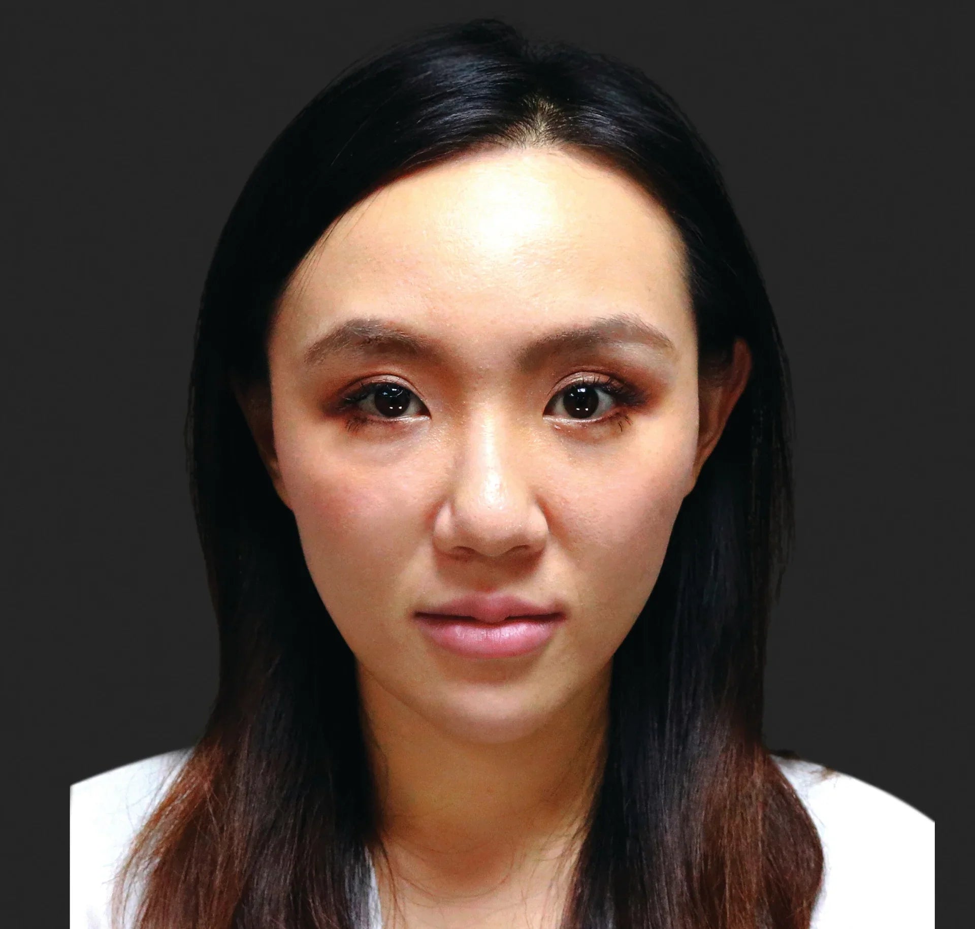 Ellanse vs Profhilo – Treatments to Enhance Your Appearance
