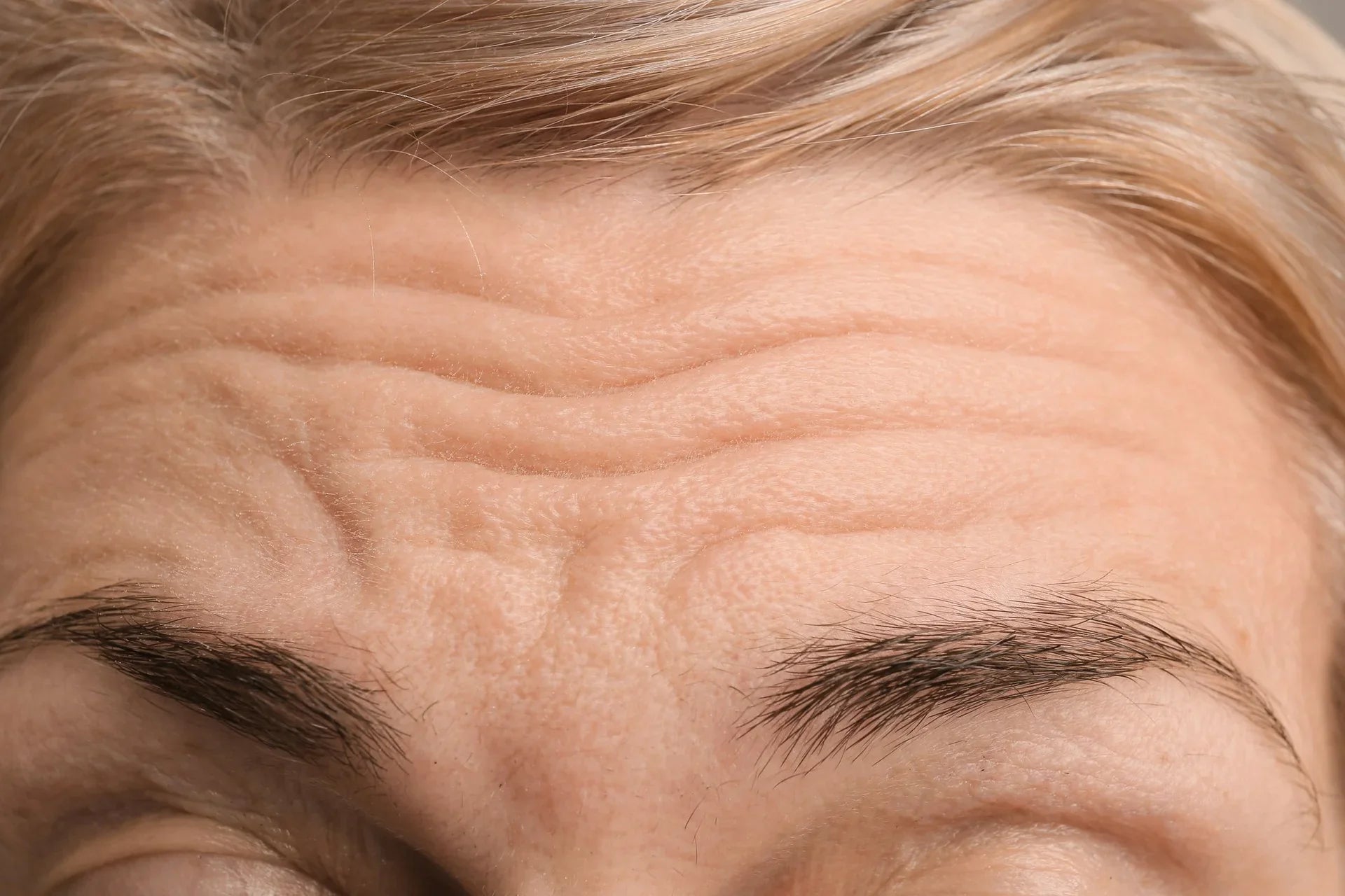 How to get rid of forehead wrinkles without botox