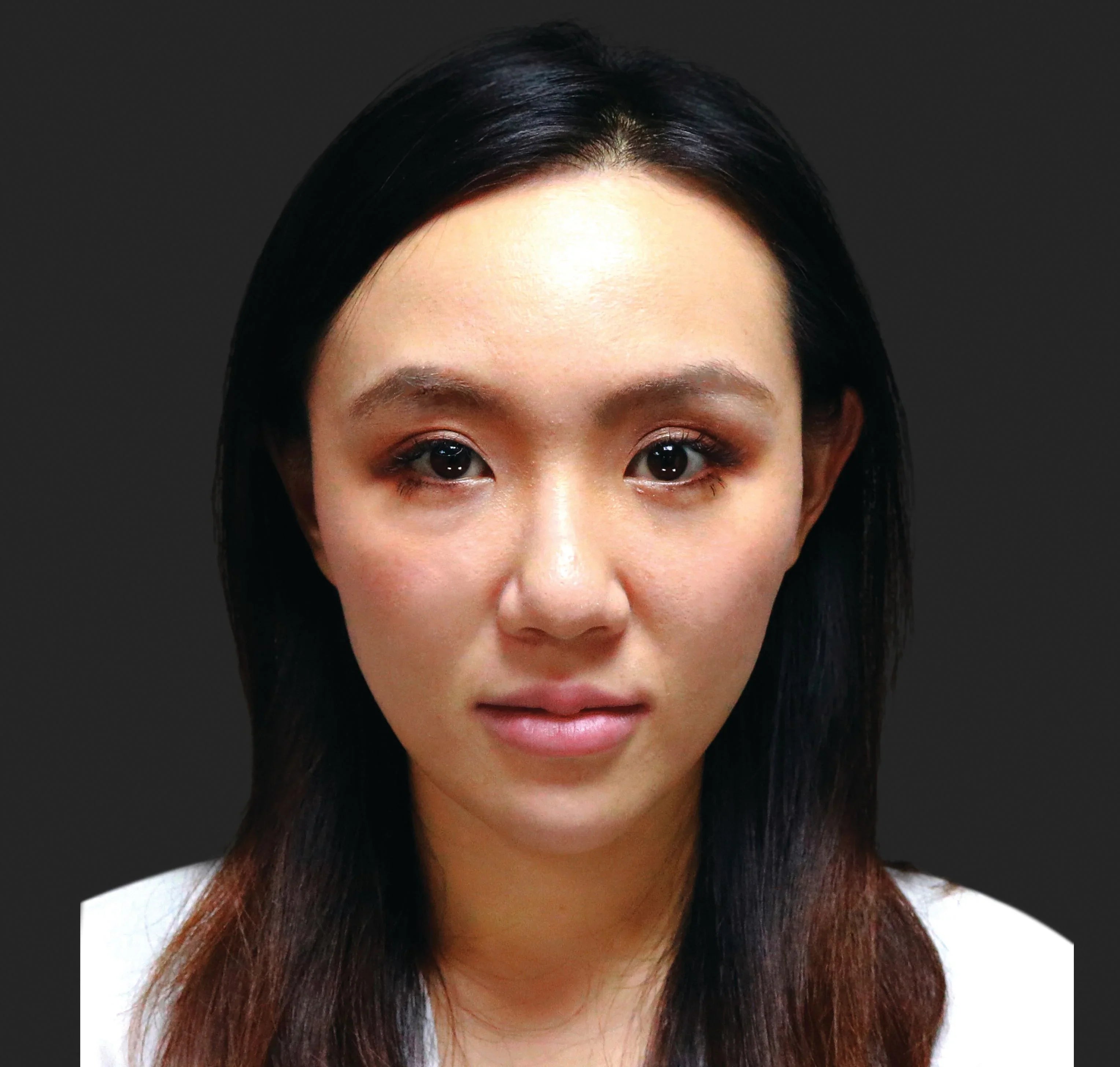 Ellanse Collagen Stimulator: Everything You Need To Know
