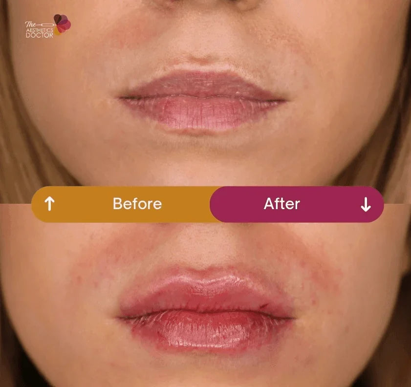 How to Make Lip Fillers Last Longer: Expert Tips for Prolonged Results