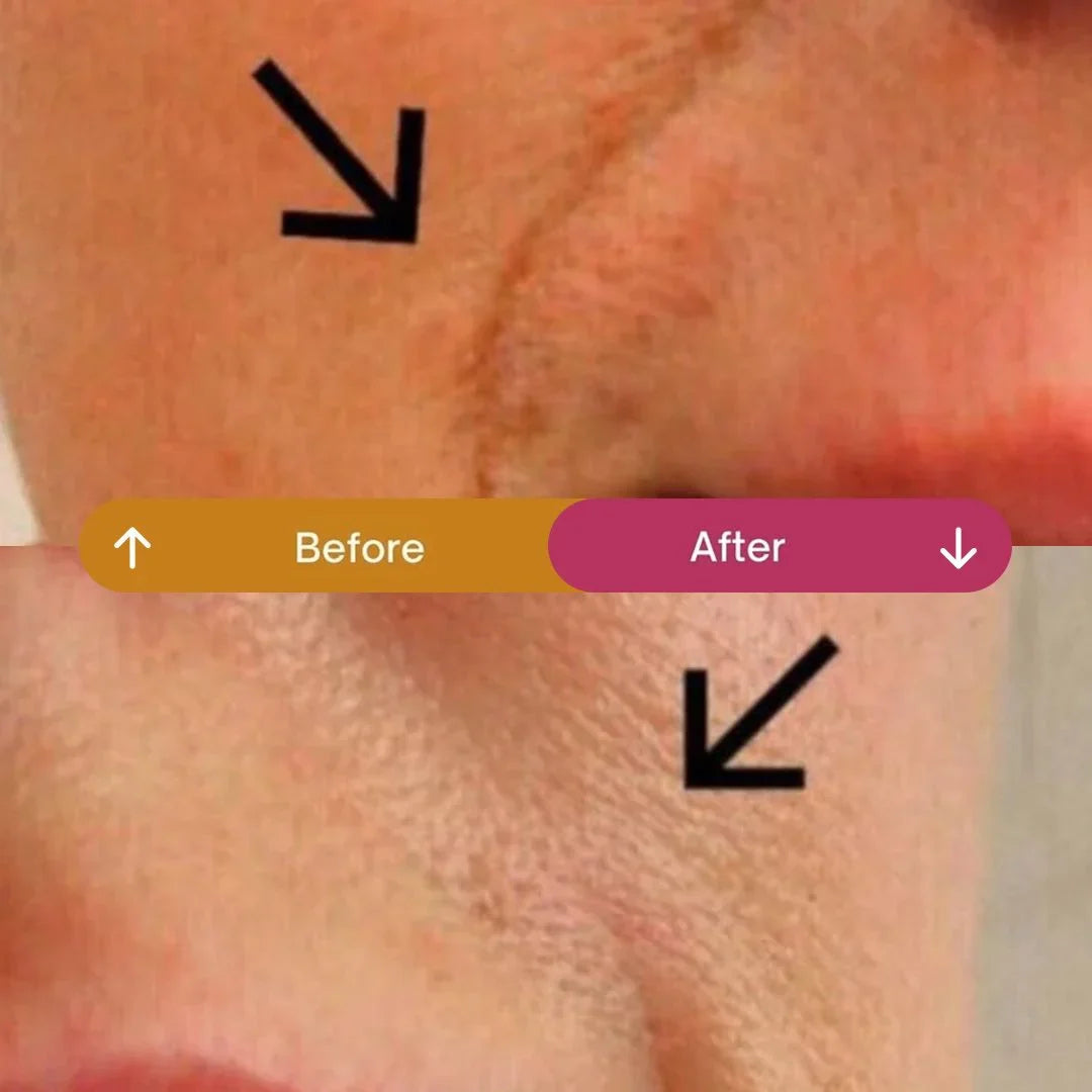 Botox for Forehead Lines: The Subtle Smooth