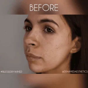 Why Aftercare for Nasolabial Fold Treatment Is So Important