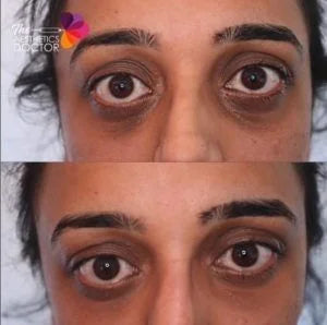 A Guide To Tear Trough Fillers