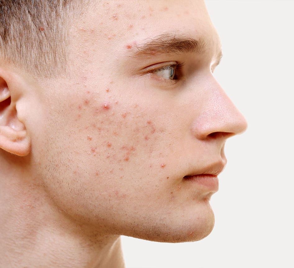 The Best Acne Treatments to Improve Your Skin in 2024