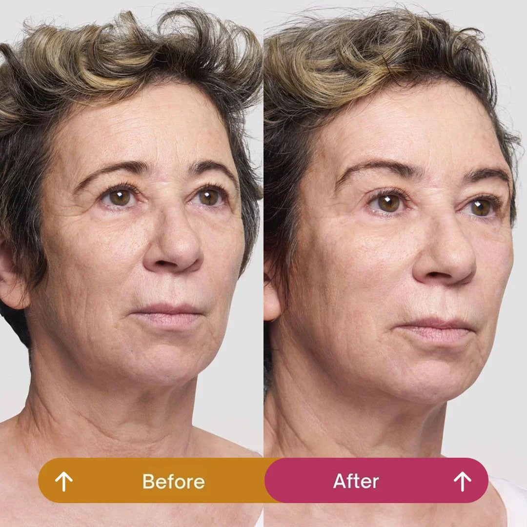 Can Botox Give Me a More Lifted Look Around the Eyes?