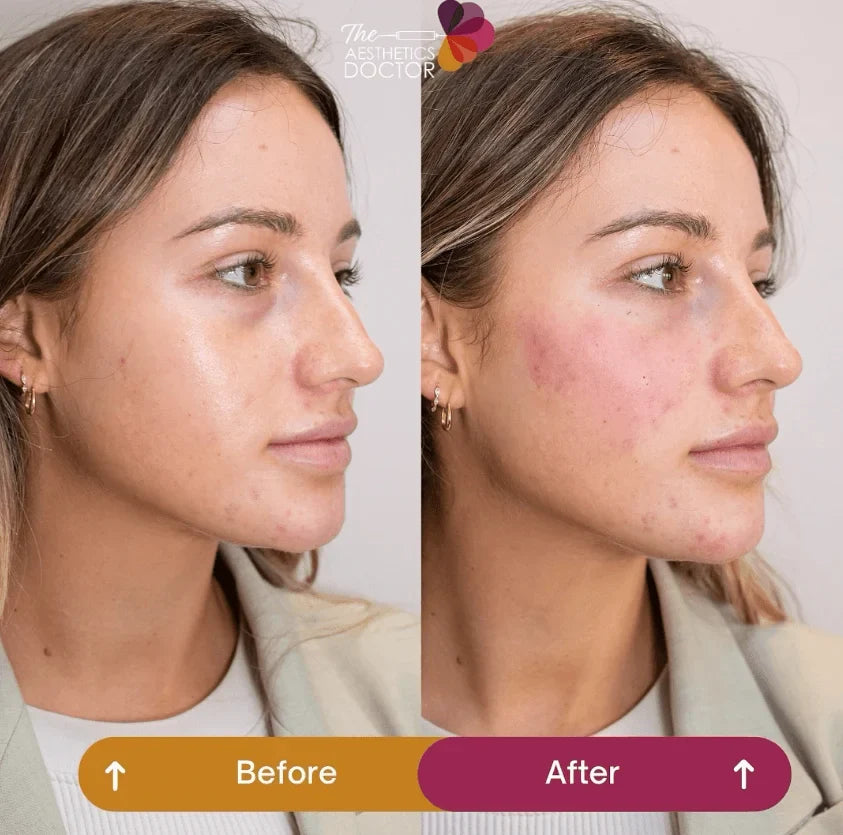 Cheek Dermal Fillers