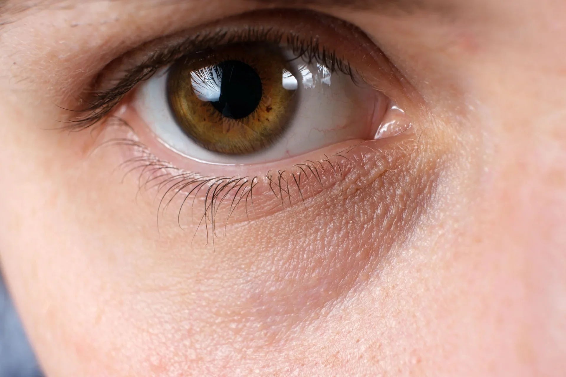 A guide to under eye filler treatment
