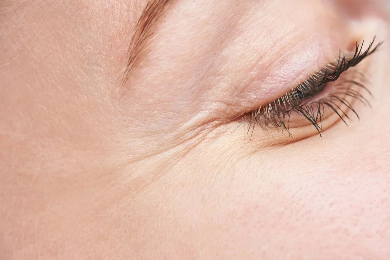 Botox for Crow’s Feet: Dr Ahmed’s Go-To for Softer, Brighter Eyes