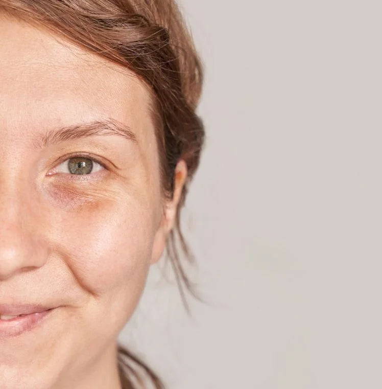 The Dark Circle Fix: Dr Ahmed’s Guide to Brighter Eyes