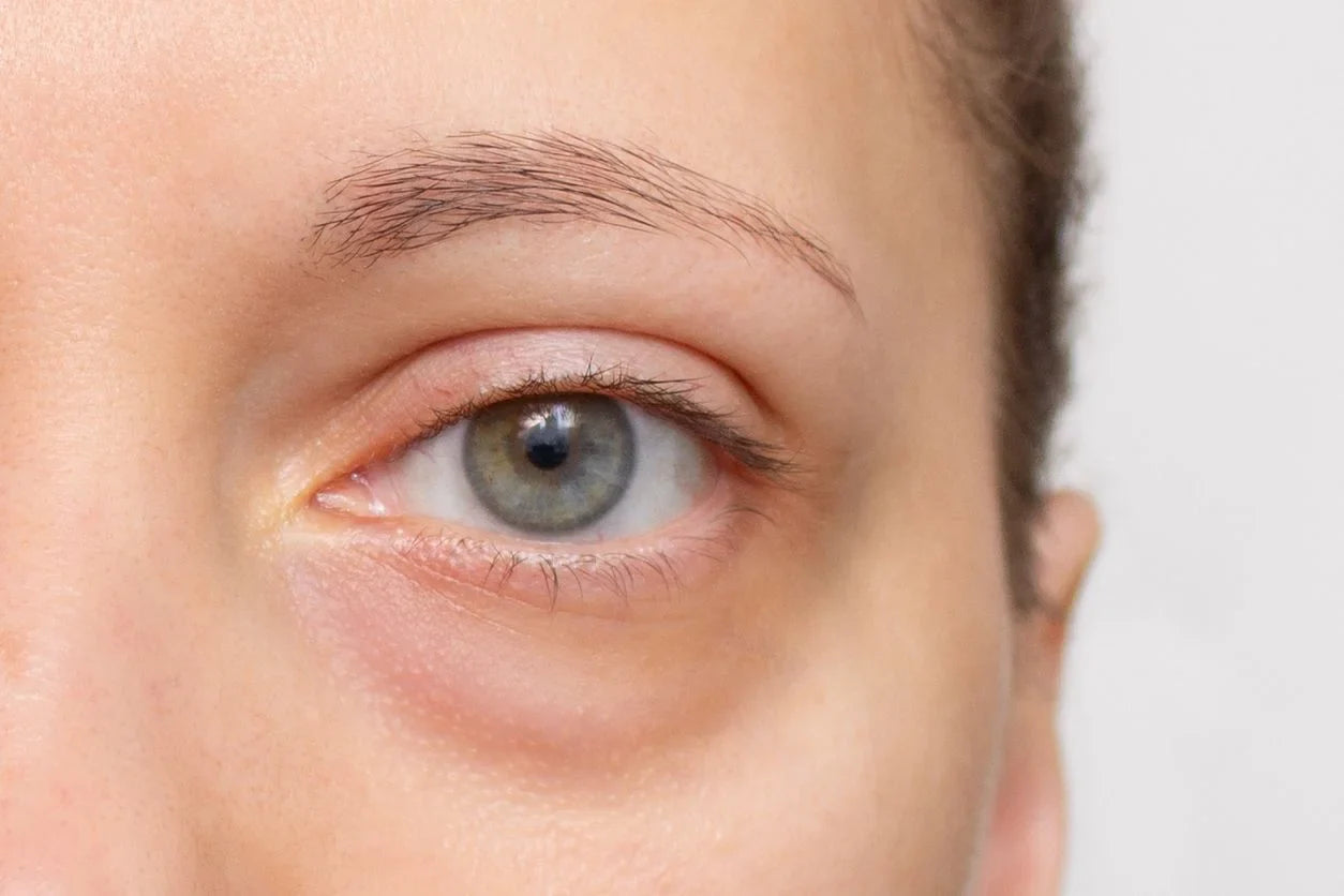 Can Botox Help with Hooded Eyes?