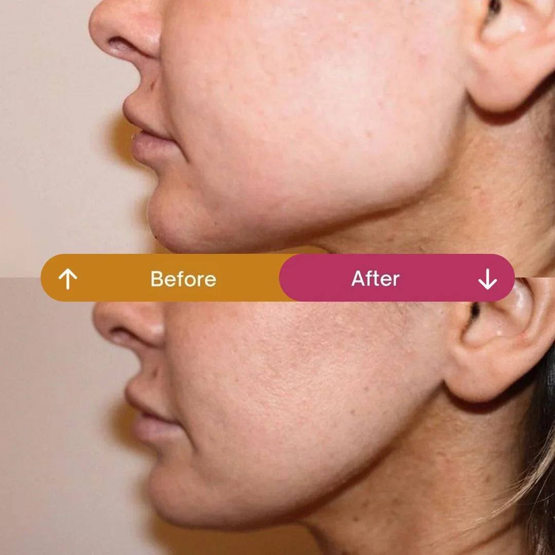 Masseter Botox: How Long It Lasts and What to Know?