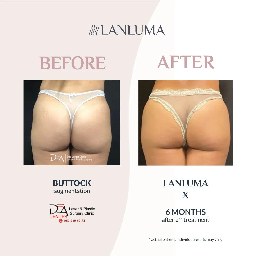 Give Your Behind a Boost with LanLuma Non-Surgical Bum Lift