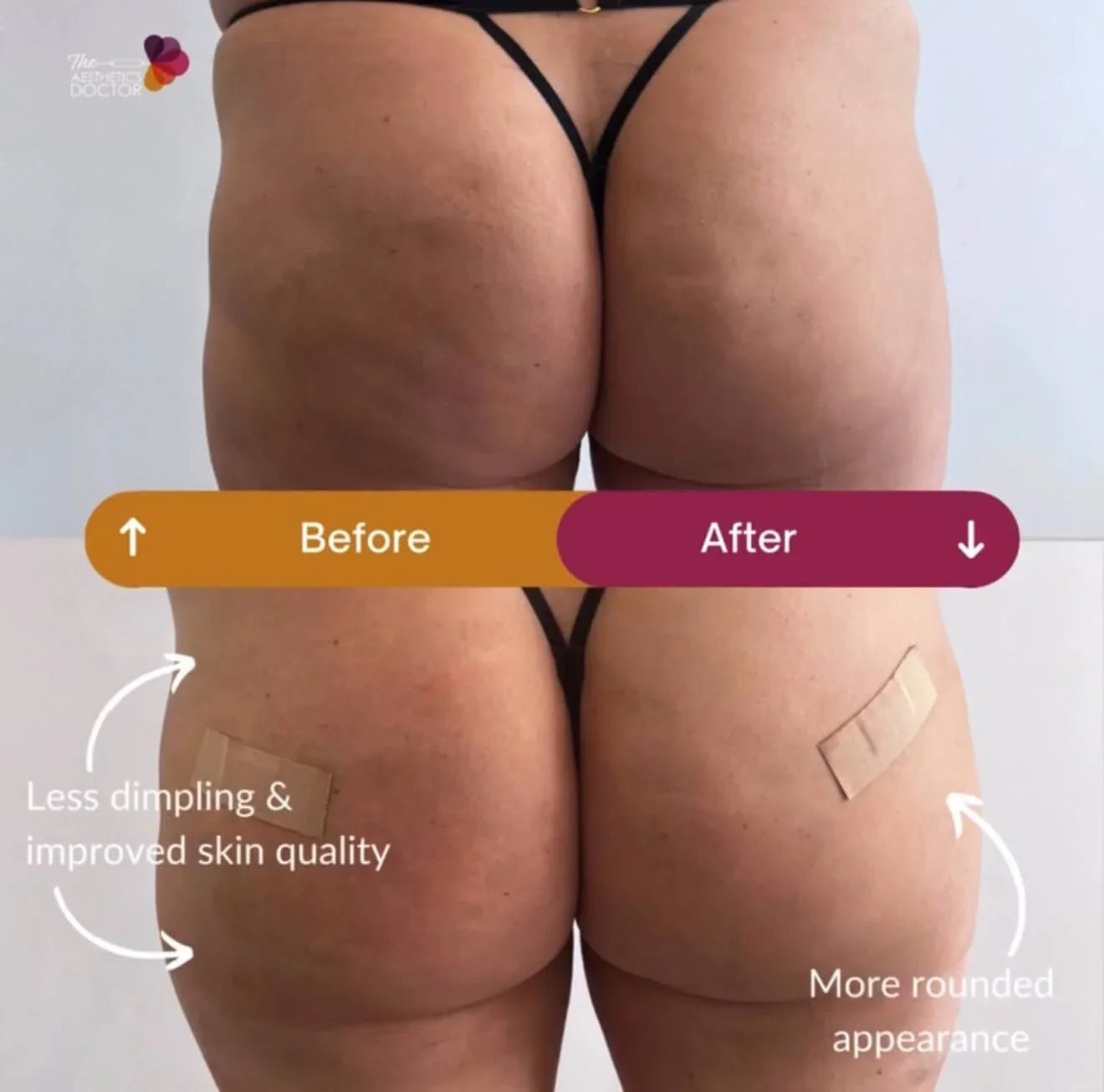 Non-surgical Butt Lift: A Comprehensive Guide