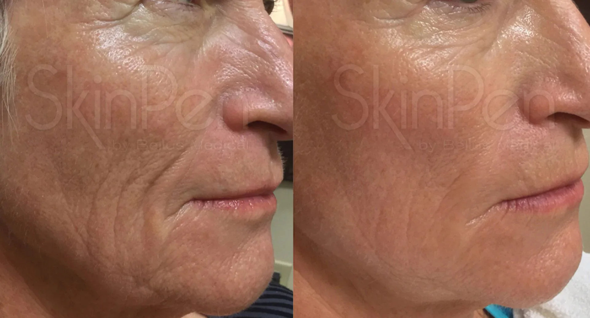 9 Amazing Benefits of Microneedling To Uplift Your Skin