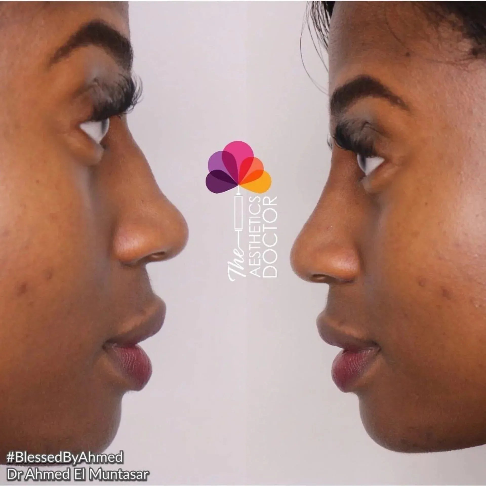 Answering The Most Common Non-Surgical Rhinoplasty Questions