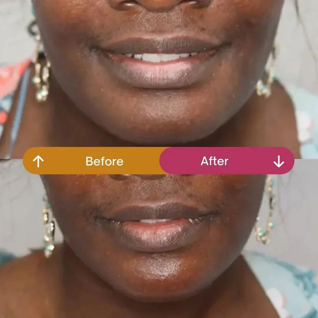 The Aesthetics Doctor – Can Botox Give You a Slimmer Face?