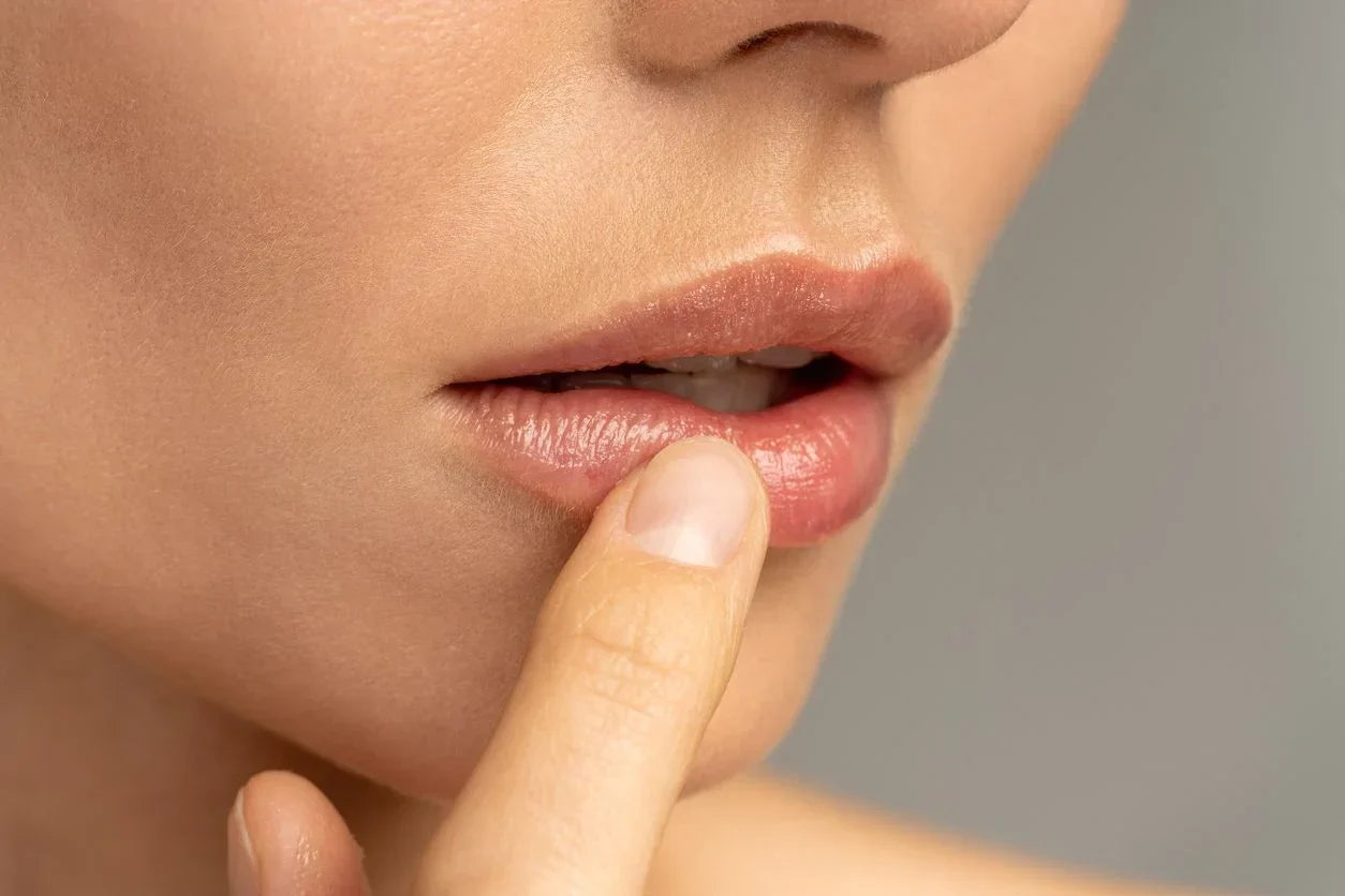 How to Prevent and Treat Lip Filler Migration