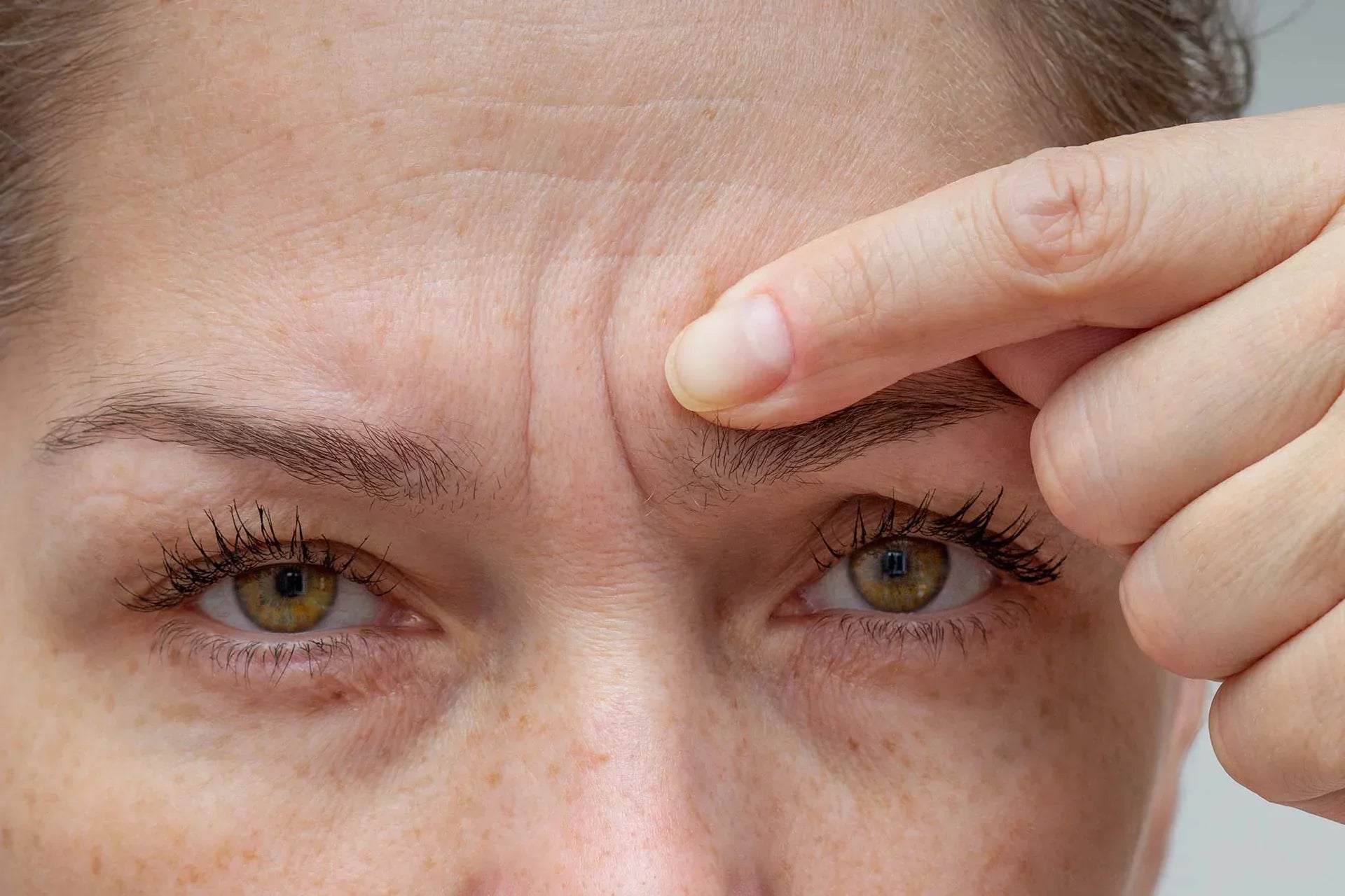 How to get rid of frown lines?