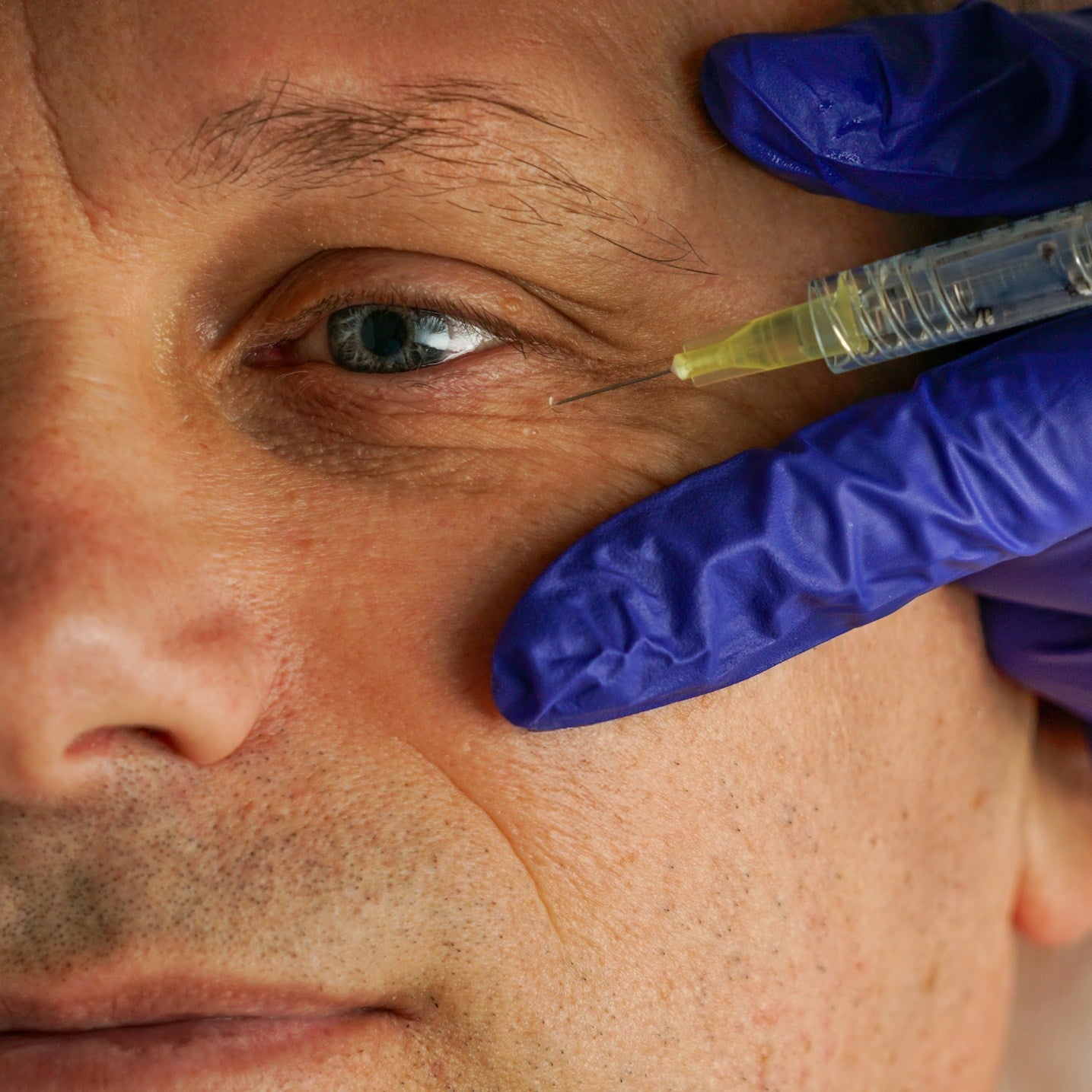 Anti Wrinkle Treatment Image 2