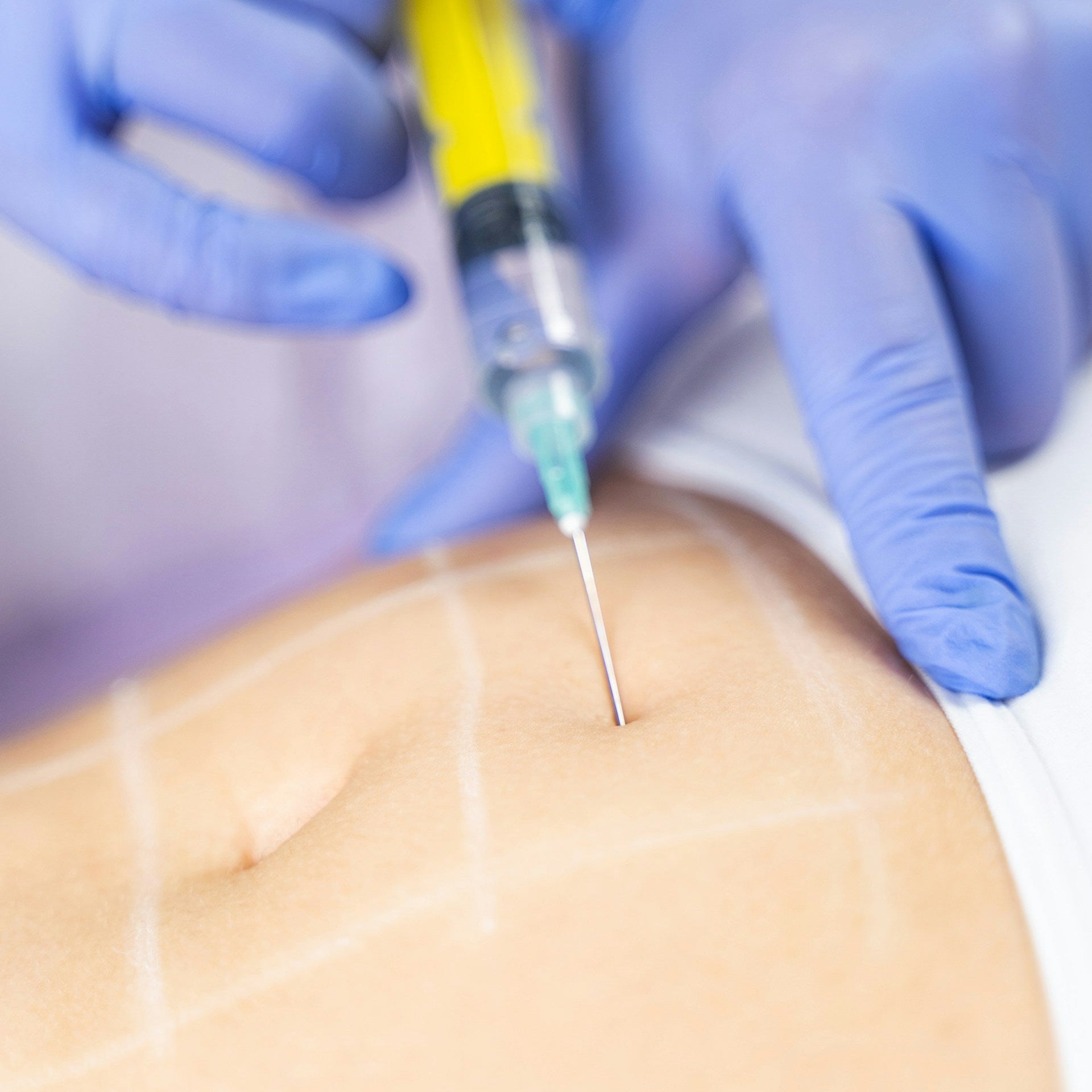 Aqualyx Fat Dissolving Injections Treatment image 3