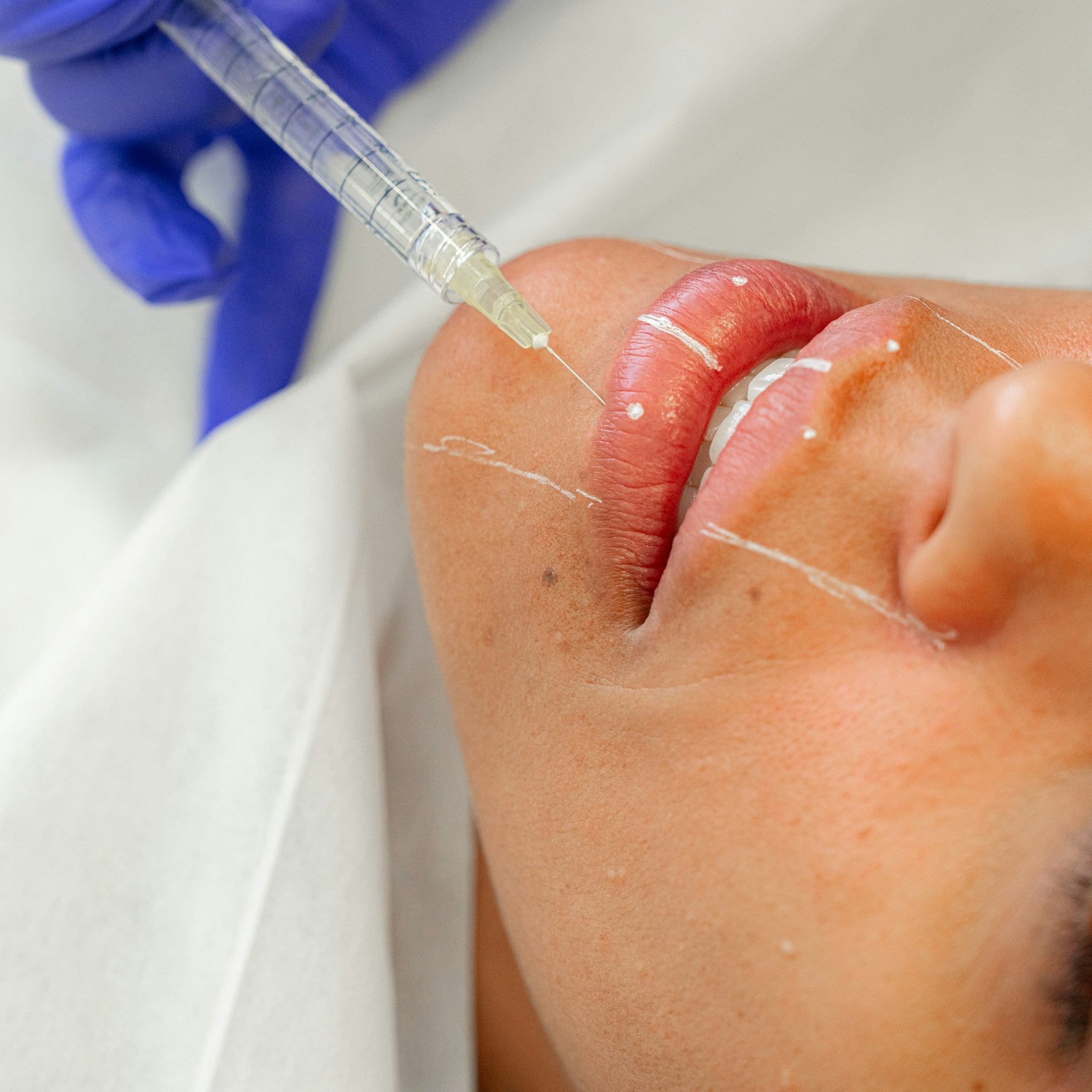 Chin Filler Treatment Image 1