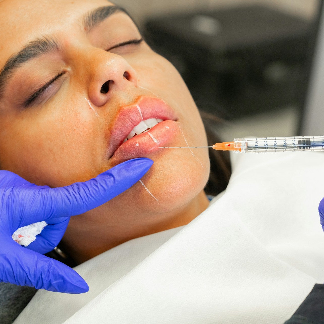 Chin Filler Treatment Image 2