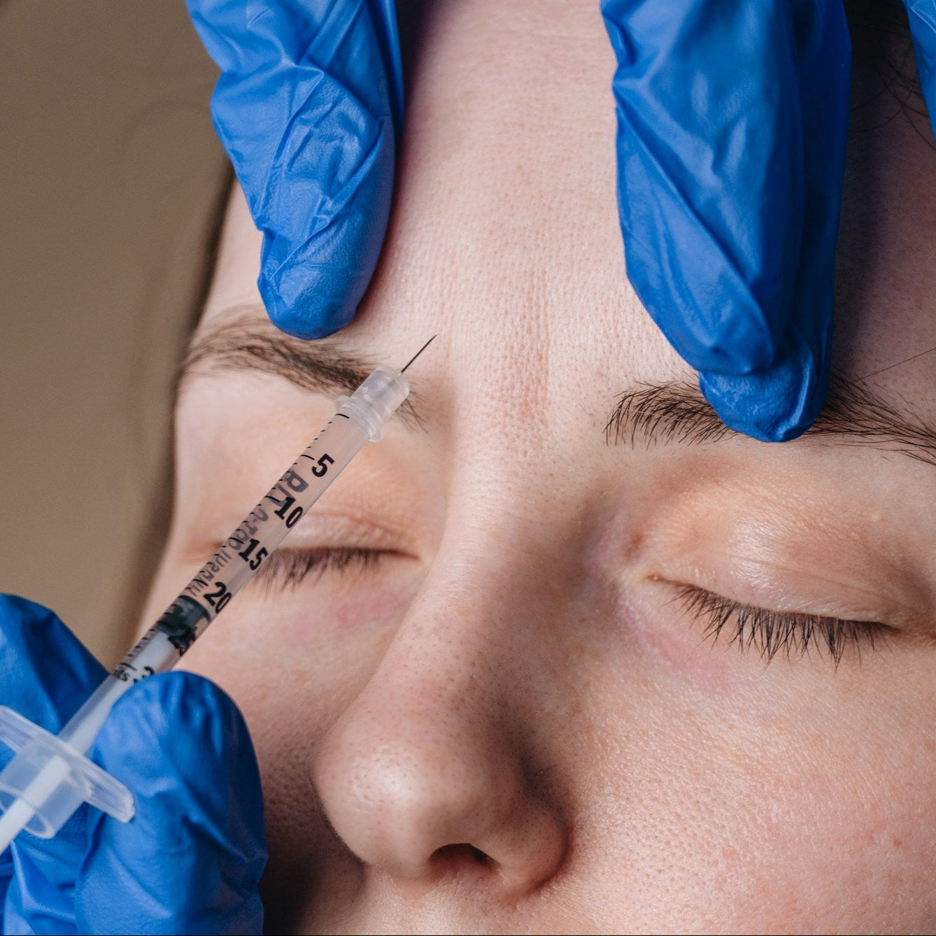 Dissolving Filler Treatment Image 1