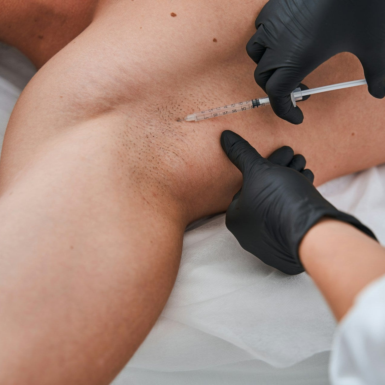 Excess Sweating Hyperhidrosis treatment Image 2