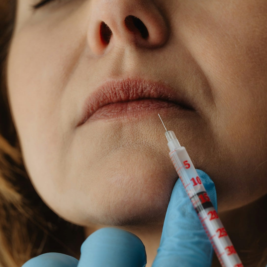 Lip filler Treatment Image 3