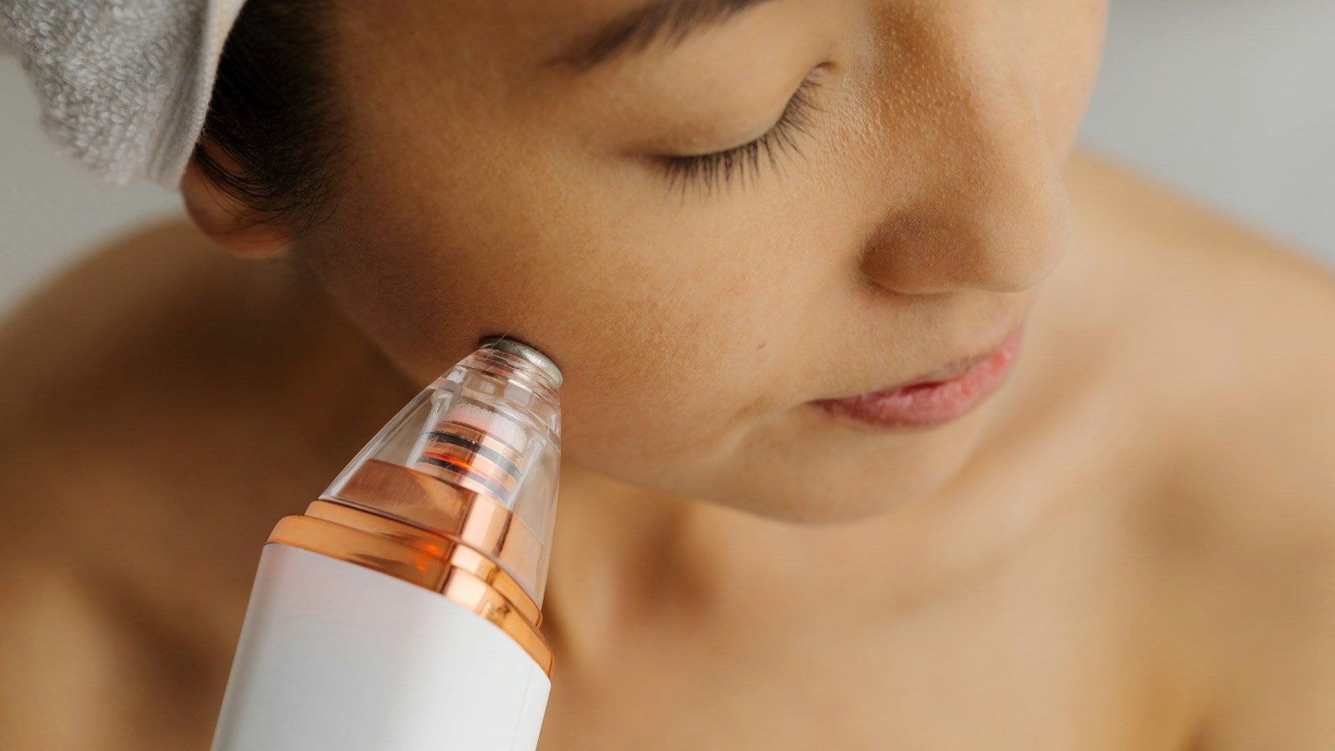 Microneedling Treatment