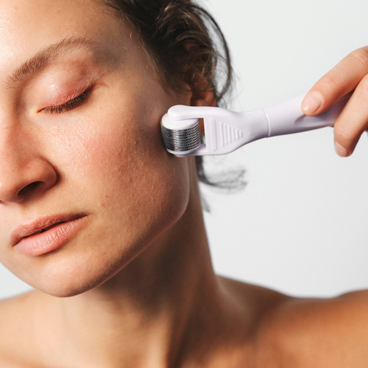Microneedling Treatment Image 2