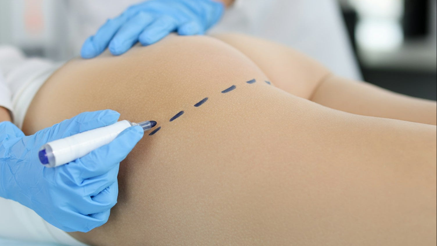 non surgical bbl treatment